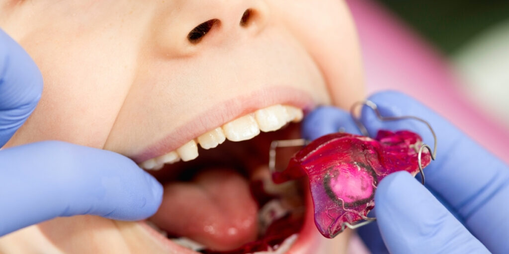 aparat ortodontyczny ruchomy dla dzieci