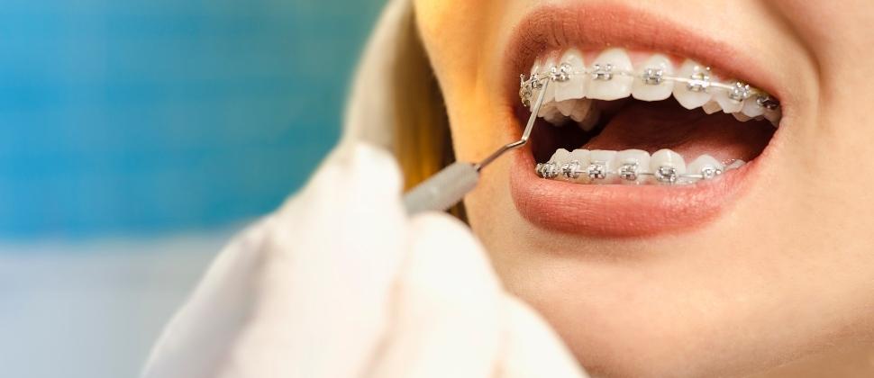 leczenie zębów a aparat ortodontyczny