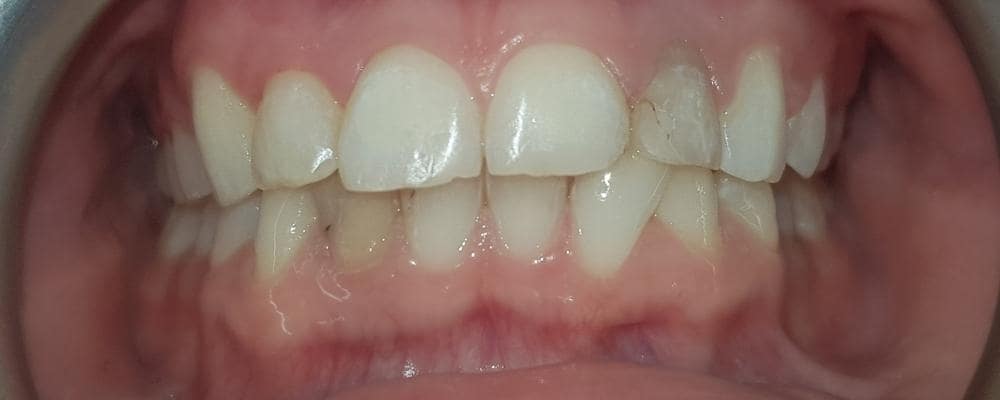leczenie ortodontyczne aparat samoligaturujący po