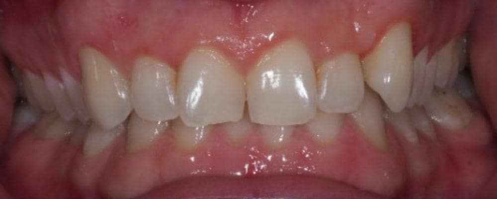 leczenie ortodontyczne invisalign przed