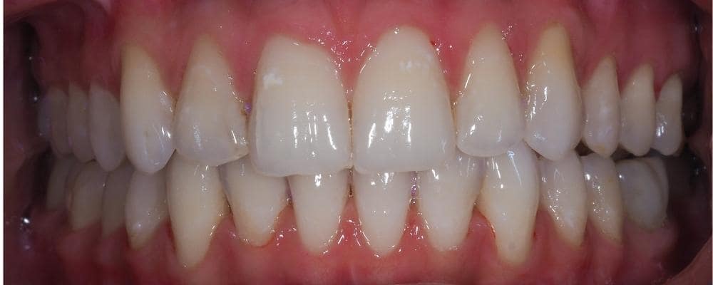 ortodoncja invisalign po