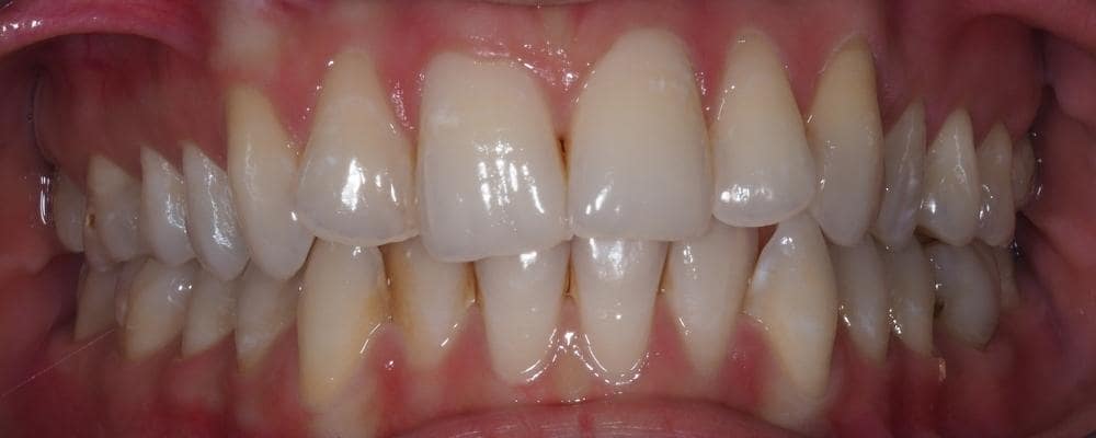 ortodoncja invisalign przed