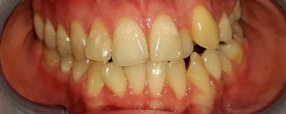 ortodoncja invisalign leczenie przed